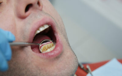 How Smoking and Coffee Stain Your Teeth—and How to Reverse It?