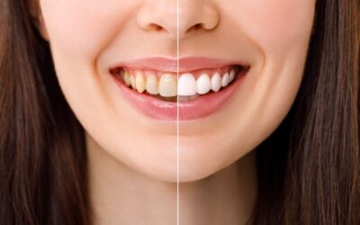 Travel-Friendly Teeth Whitening Tips for Summer Trips