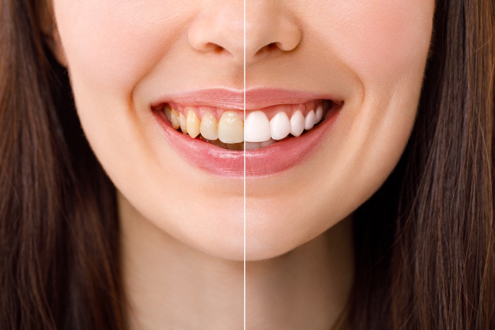 Travel-Friendly Teeth Whitening Tips for Summer Trips
