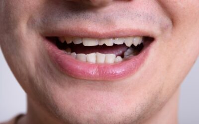 Broken or Chipped Tooth? Here’s What to Do?