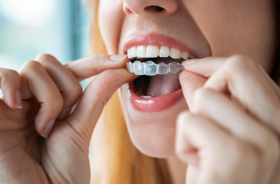 Invisalign Clear Aligners in Windsor